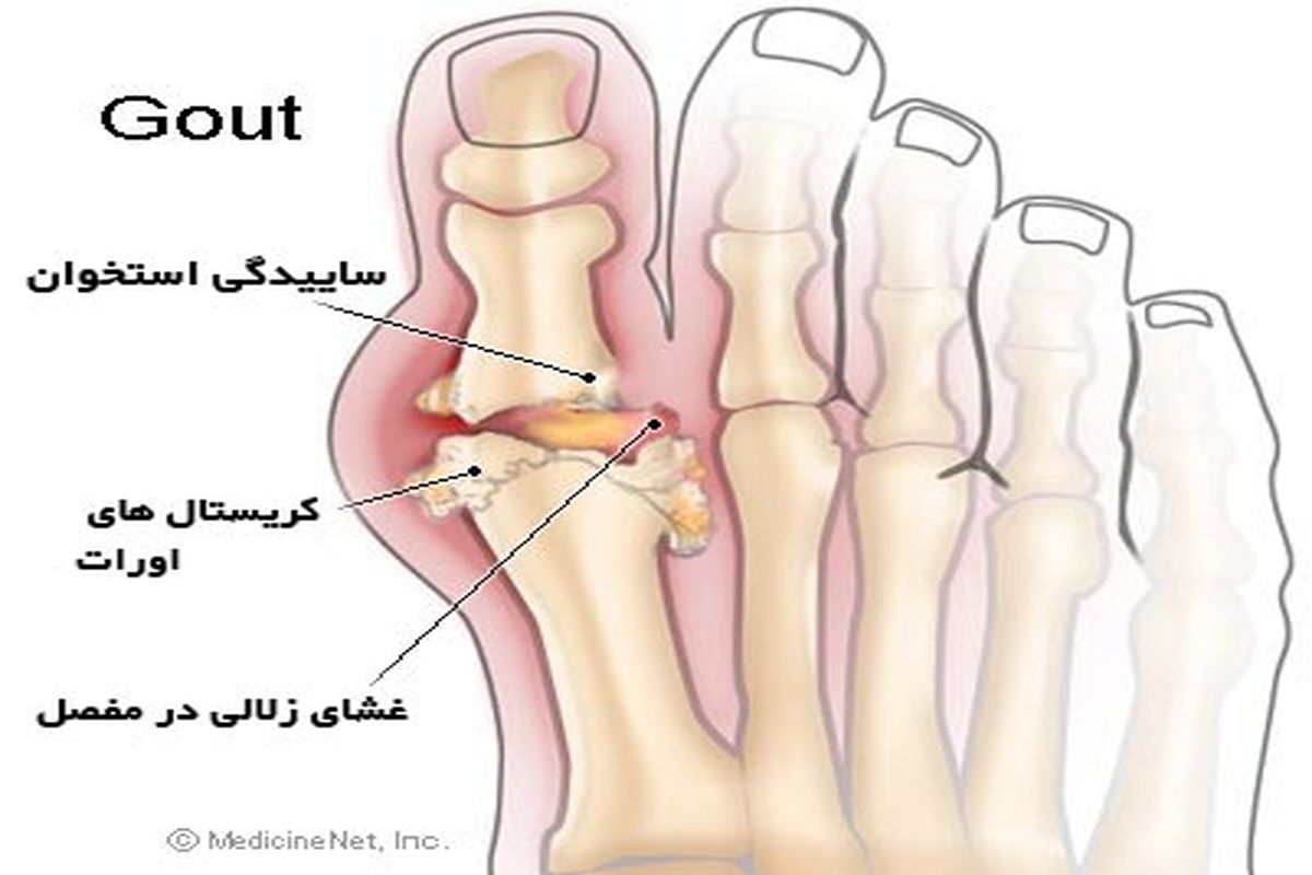 یک درمان بسیار قوی خانگی برای نقرس