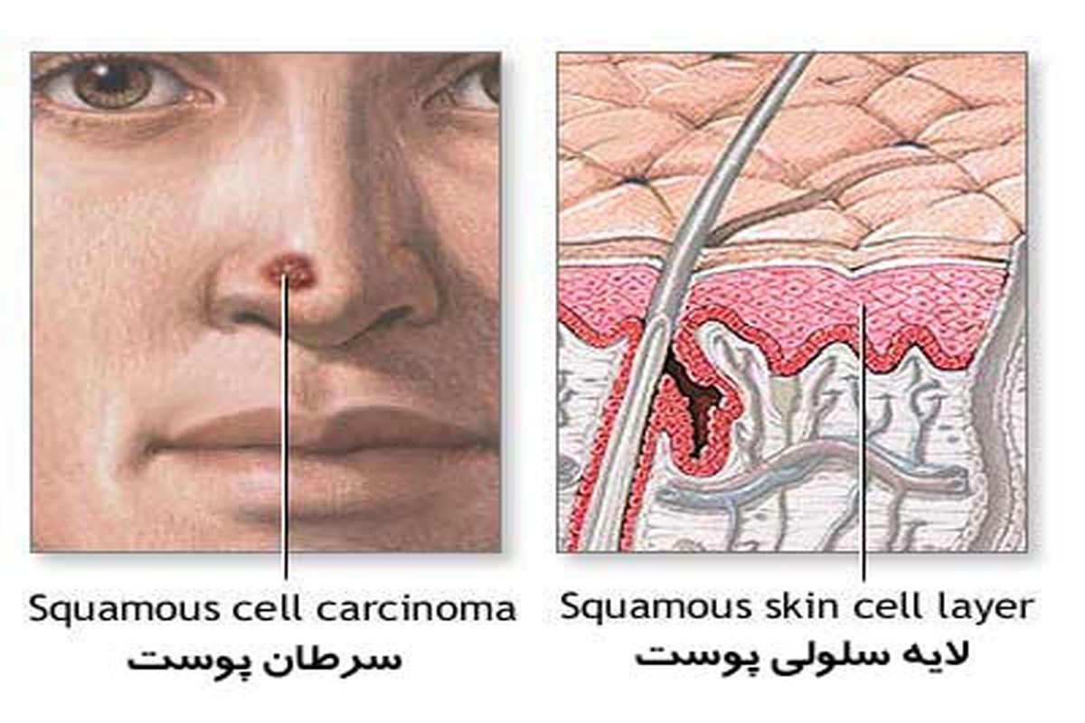 شایع‌ترین سرطان در ایران کدام است؟