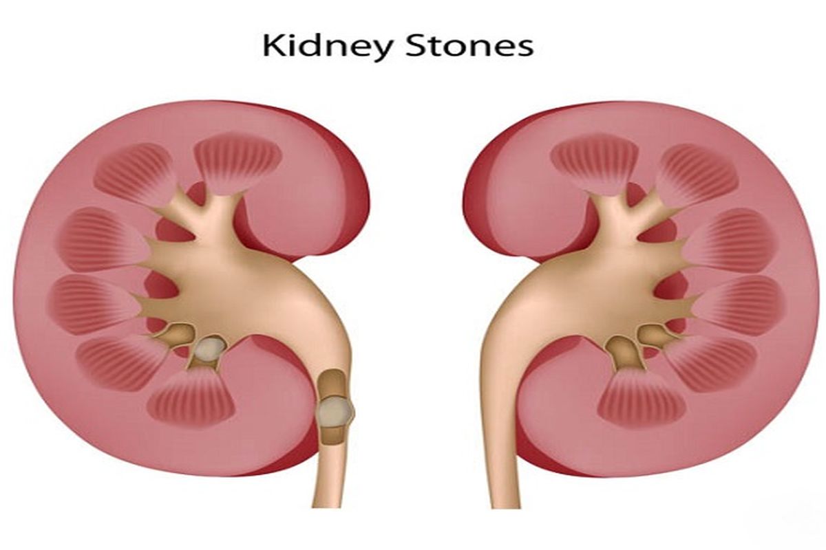 ۷ روش برای پیشگیری از سنگ کلیه