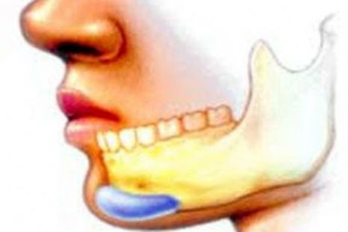 شکستگی های ناحیه فک و صورت در ایران بیش از دیگر کشورهاست