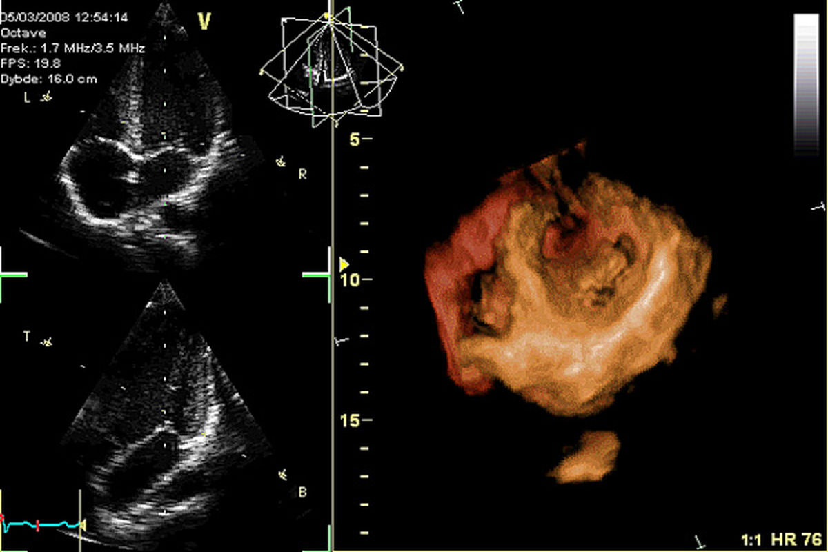اکو کاردیو گرافی سه بعدی روشی نوین برای بررسی ساختار و قدرت انقباضی قلب