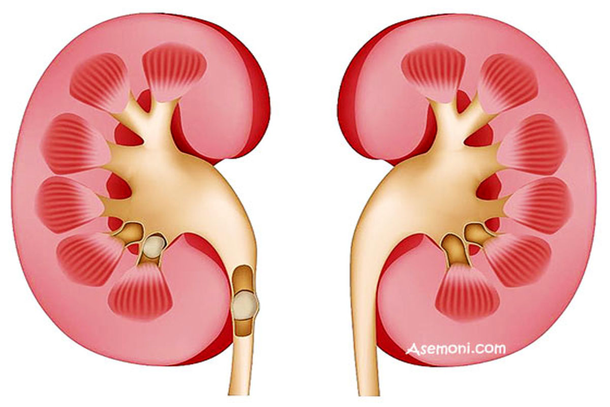 با این ۶ راه از سلامت کلیه هایتان باخبر شوید