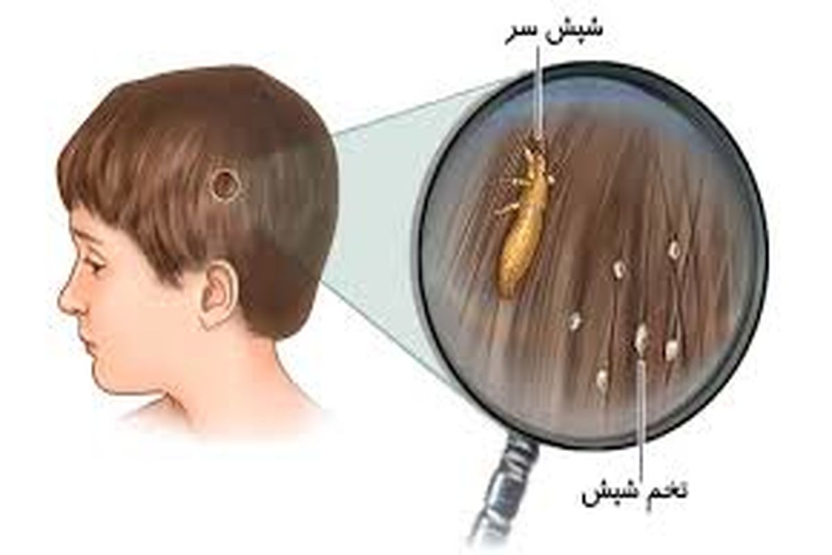 همه در معرض شپش قرار دارند