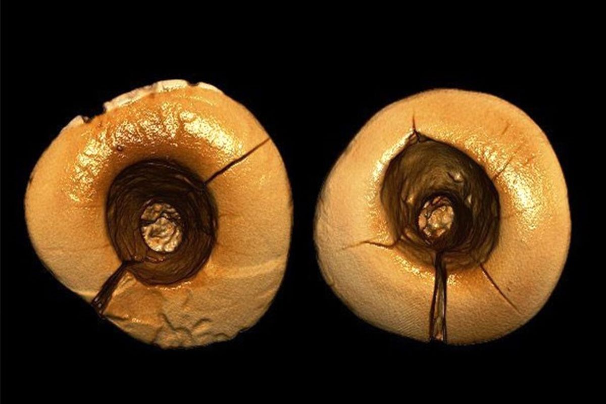 اولین دندان پر شده تاریخ کشف شد