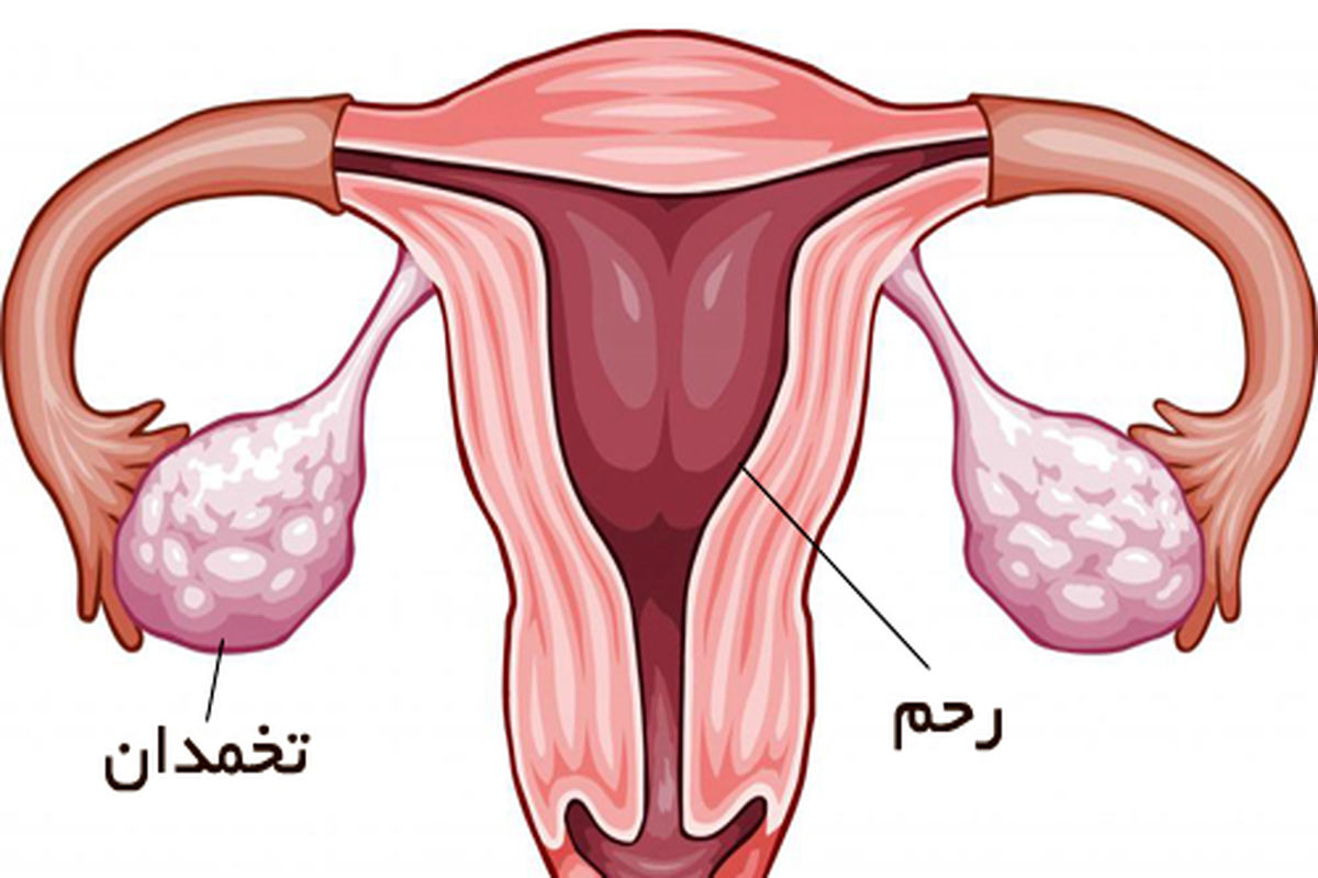 نشانه‌های ابتلا به سندروم تخمدان پلی کیستیک/ضرورت پیشگیری و درمان بیماری از دوران بلوغ