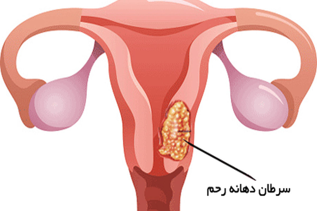 زنگ خطر سرطان های زنانه را بشناسید