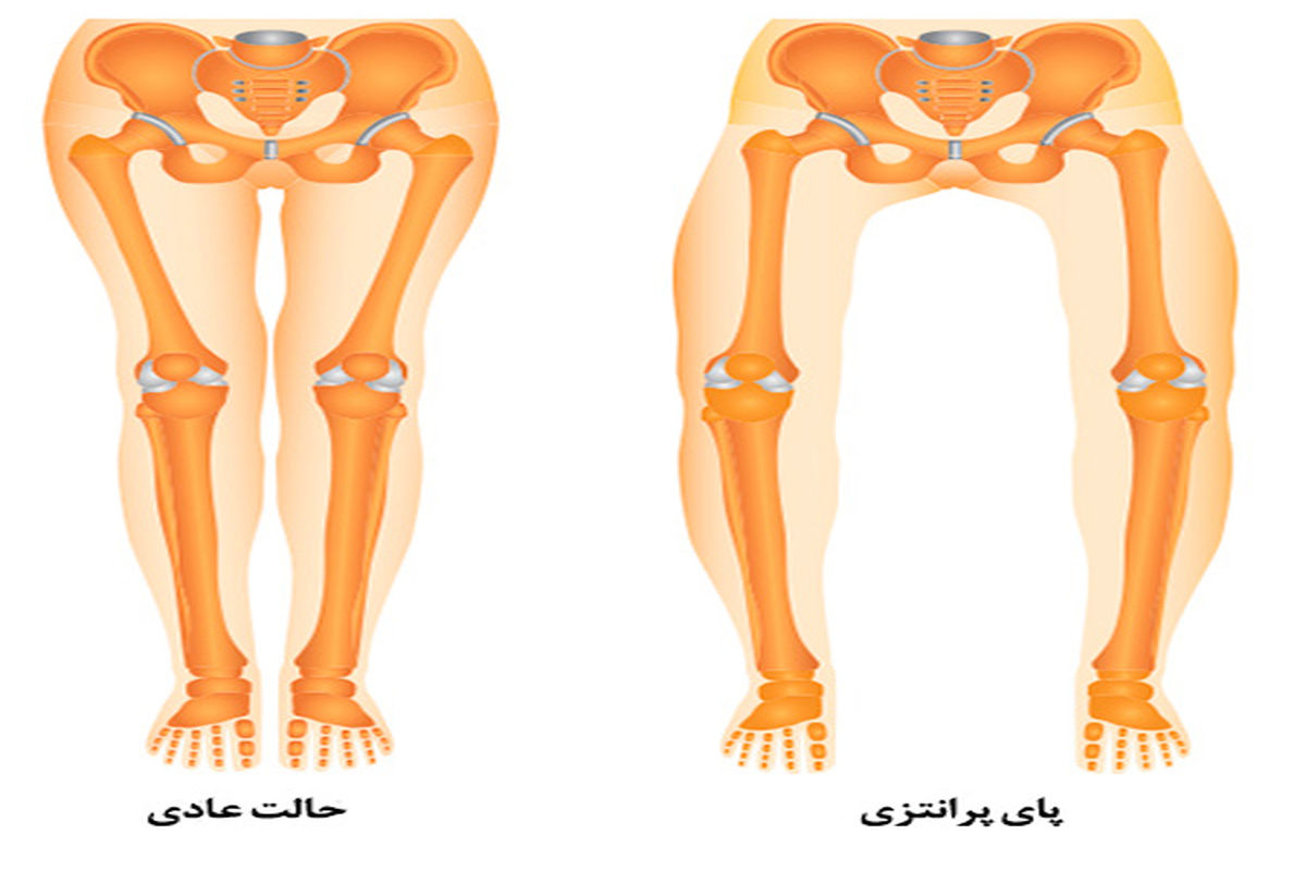 اغلب  آسیایی ها  دچار پای پرانتزی هستند