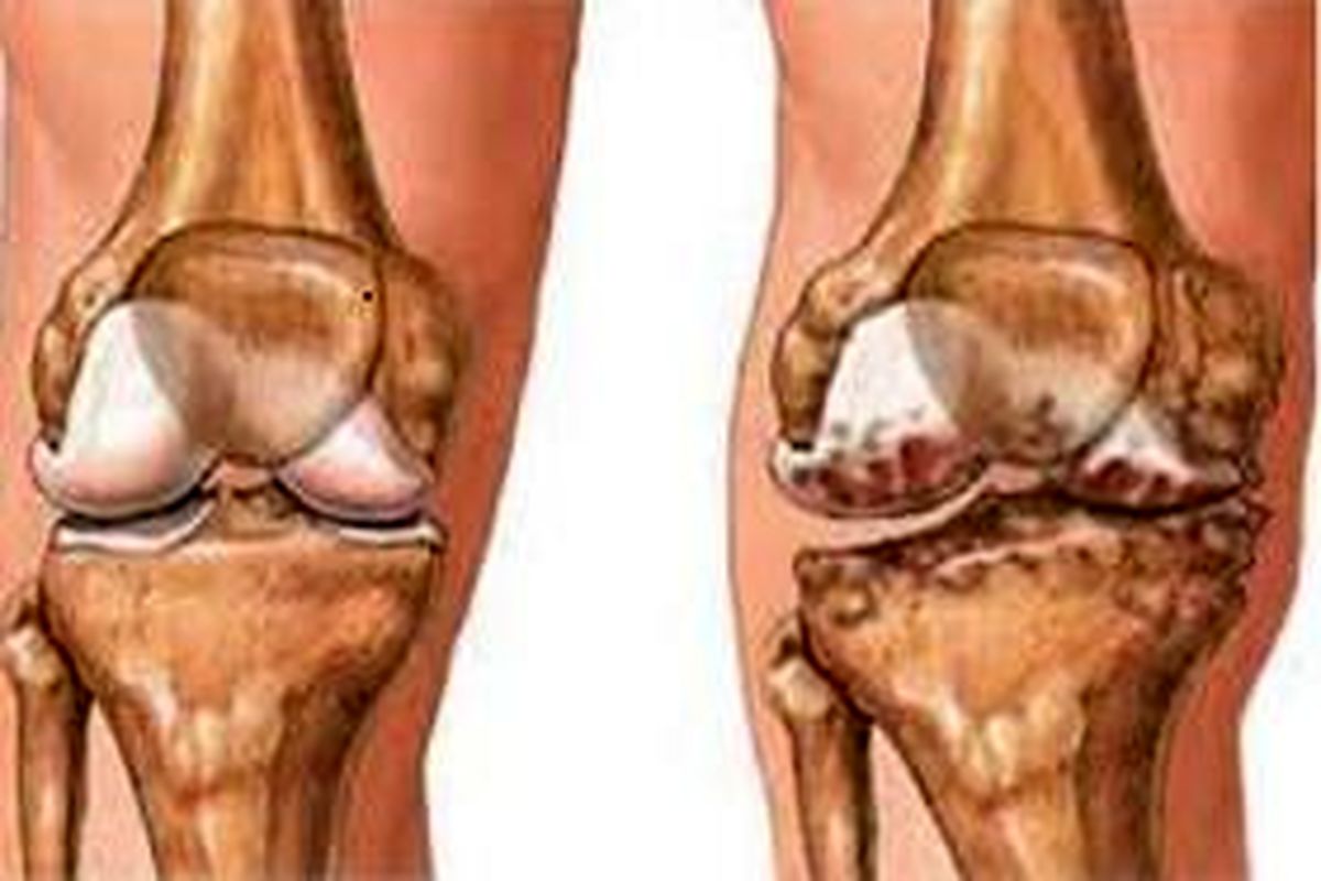 دررفتگی مفصل کشکک  زانو در زنان شایع‌تر از مردان/ابتلا به آرتروز زودرس زانو در صورت عدم درمان به موقع