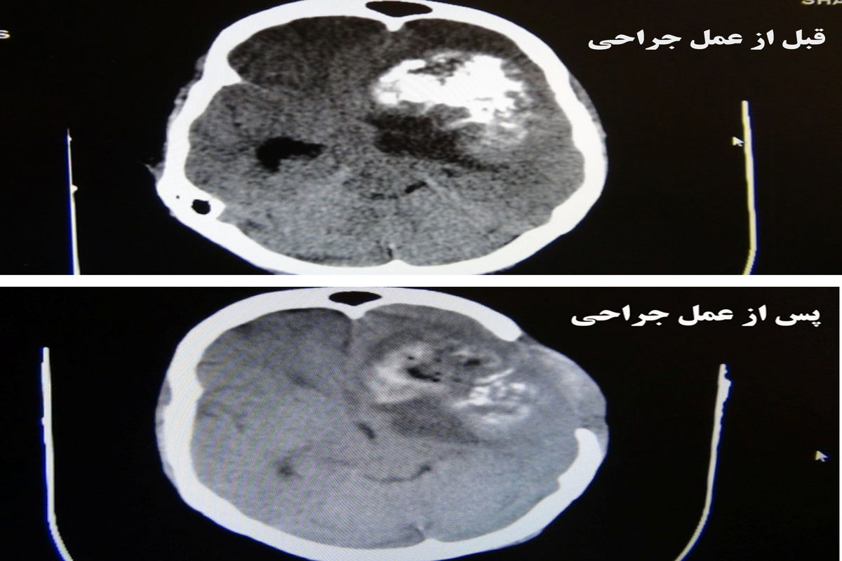 تومور بزرگ مغزی از سر خانم قمی خارج شد+عکس