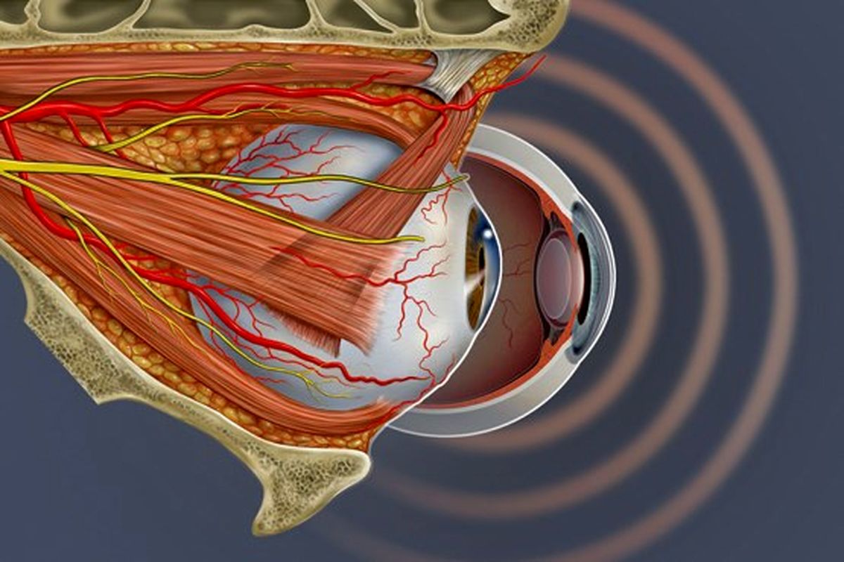 سکته چشم را بشناسید