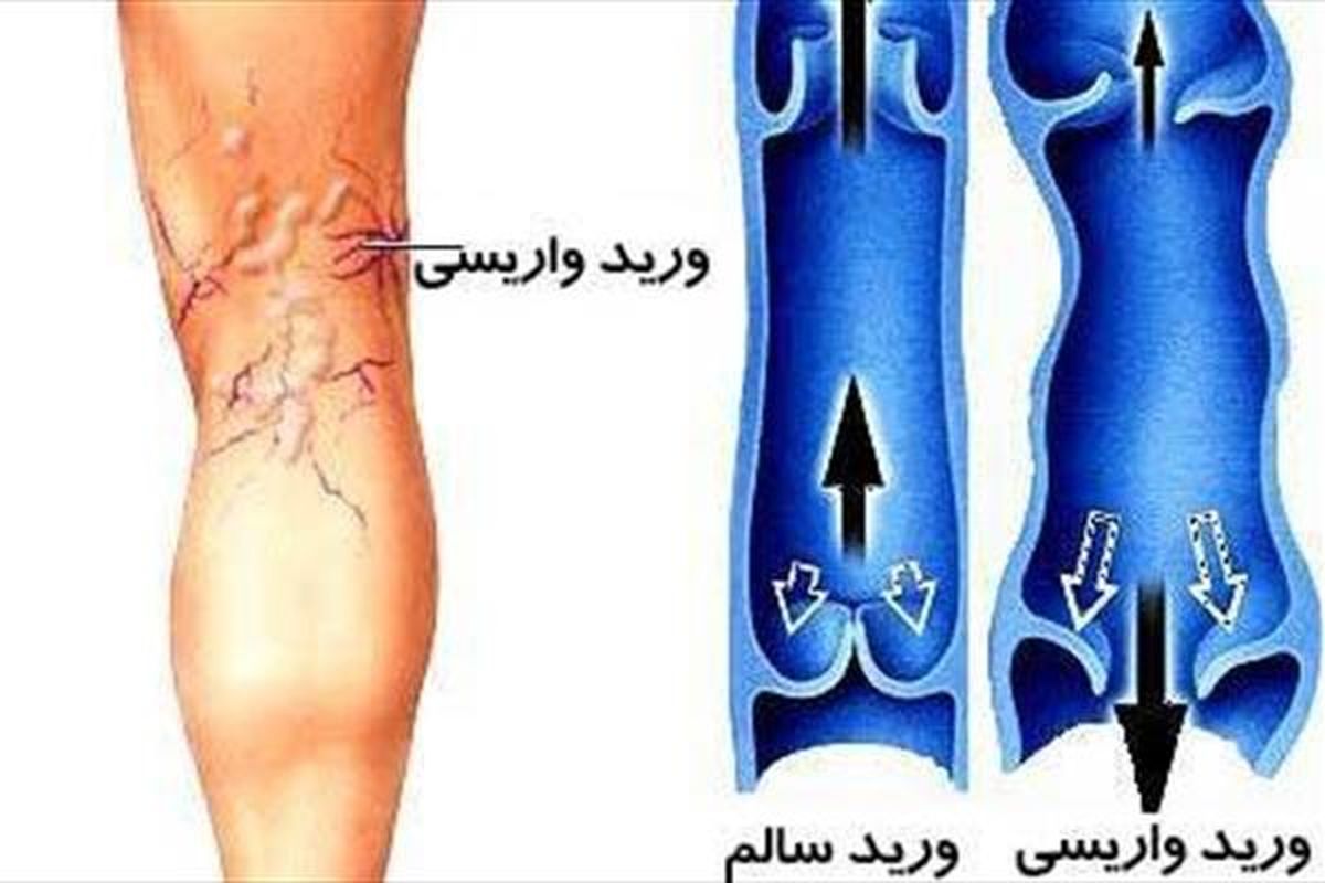 رگ بنفش روی پا نشانه واریس است؟