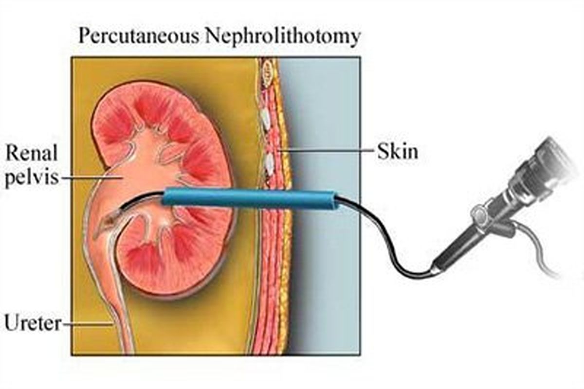 انجام عمل خارج کردن سنگ کلیه در کودک ۴ ساله به روش Mini-PCNL برای نخستین بار در خراسان شمالی