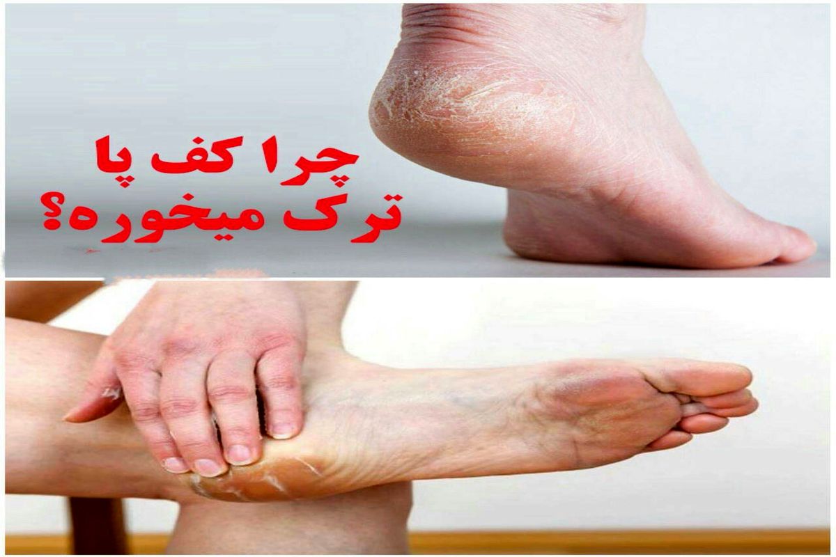 دلایل اصلی ترک پاشنه پا!