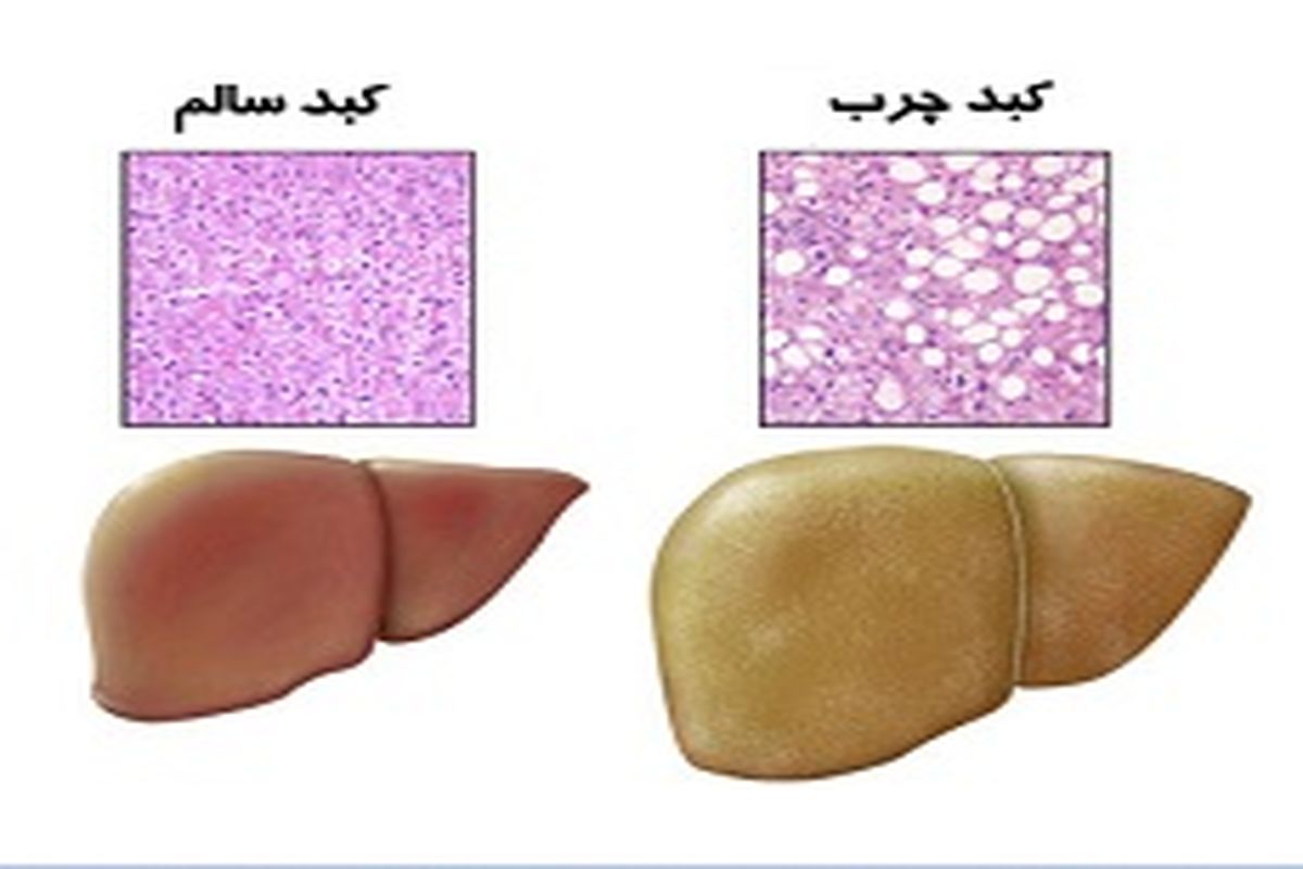 تأثیر تغییر سبک زندگی در ابتلا به کبد چرب / اهمیت رادیولوژی ویژه در کودکان