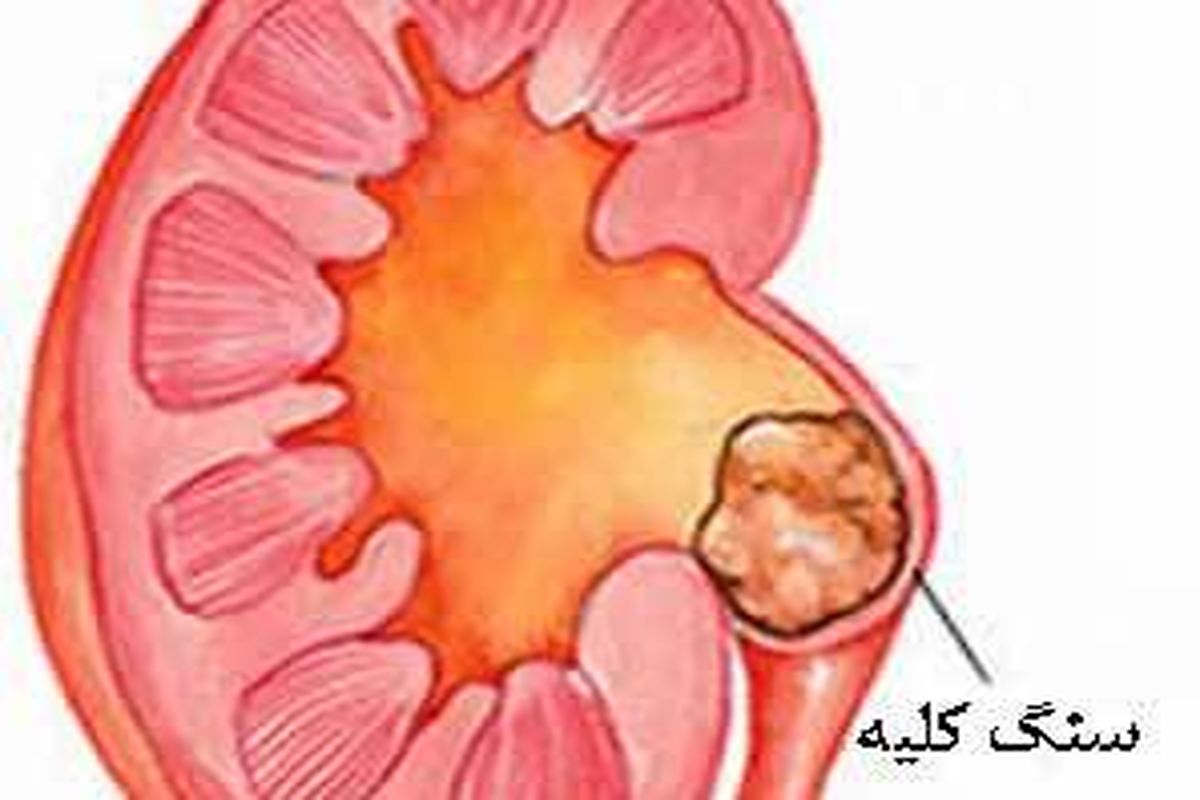 سنگ کلیه بیماری بسیار شایع