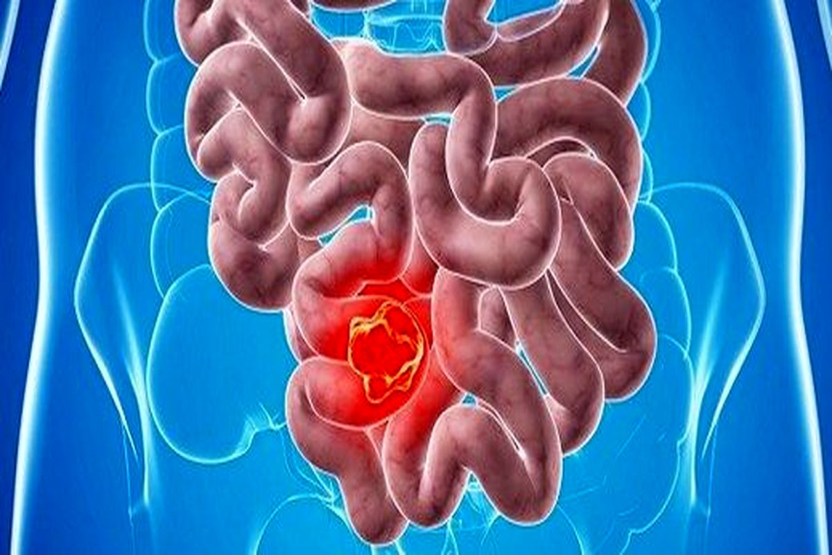 بیماری‌های گوارشی را به دست این میوه شفابخش بسپارید!