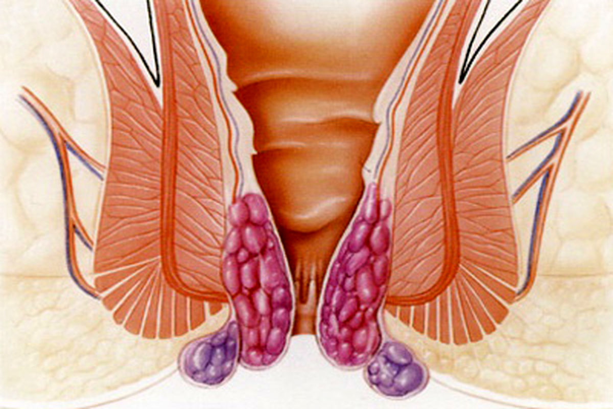 انواع هموروئید و ۴ راهکار درمان بواسیر
