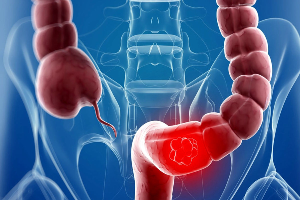 چه کسانی بیشتر به سرطان روده مبتلا می شوند؟