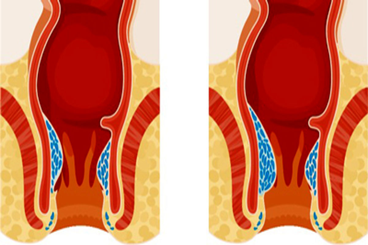 چگونه بواسیر را درمان کنیم؟