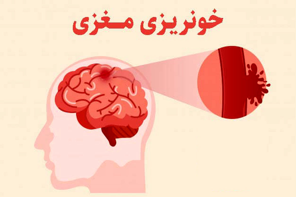 ضربه به سر در مبتلایان به هموفیلی باعث خونریزی مغزی می‌شود