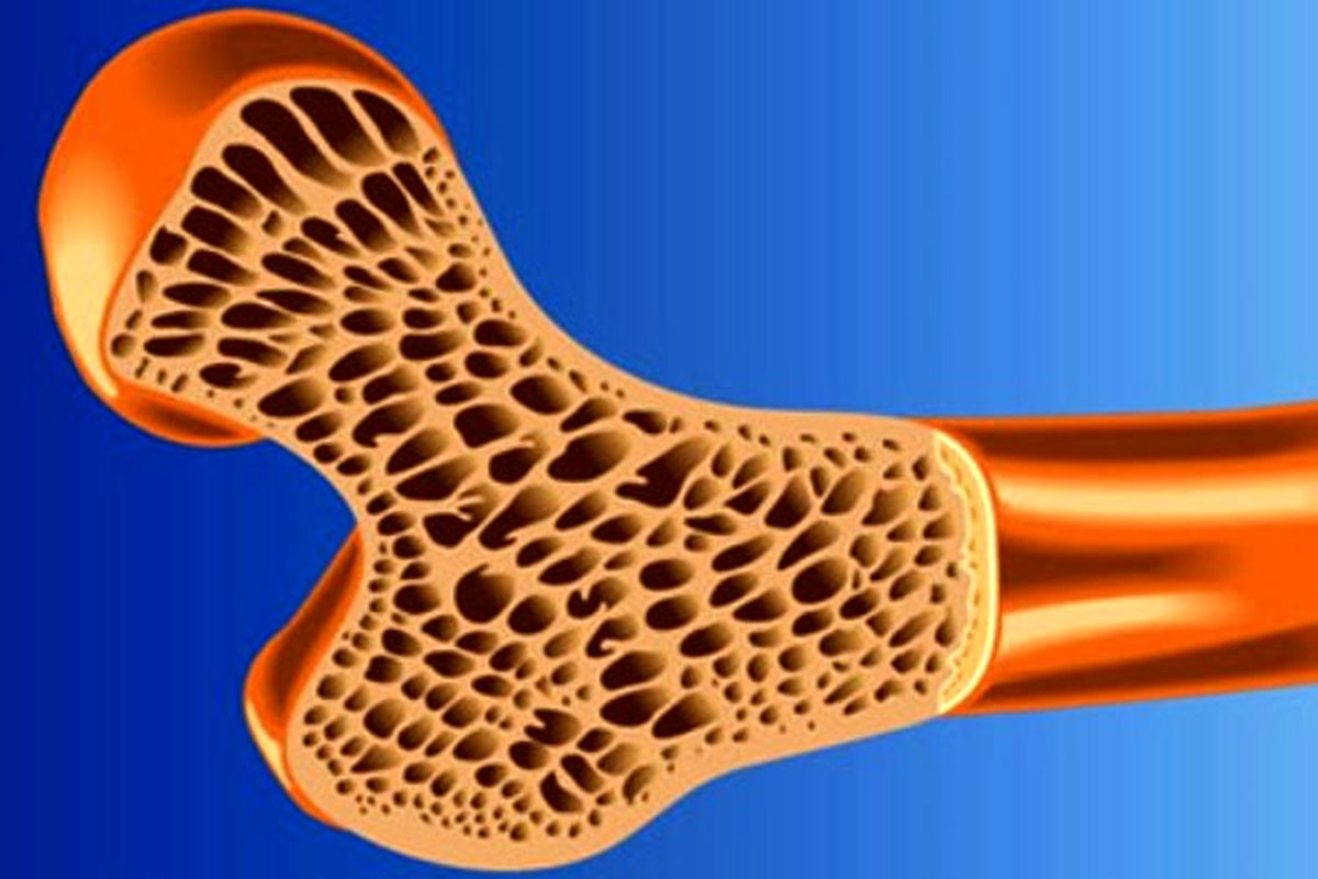 ارتباط مرگبار پوکی استخوان با بیماری قلبی
