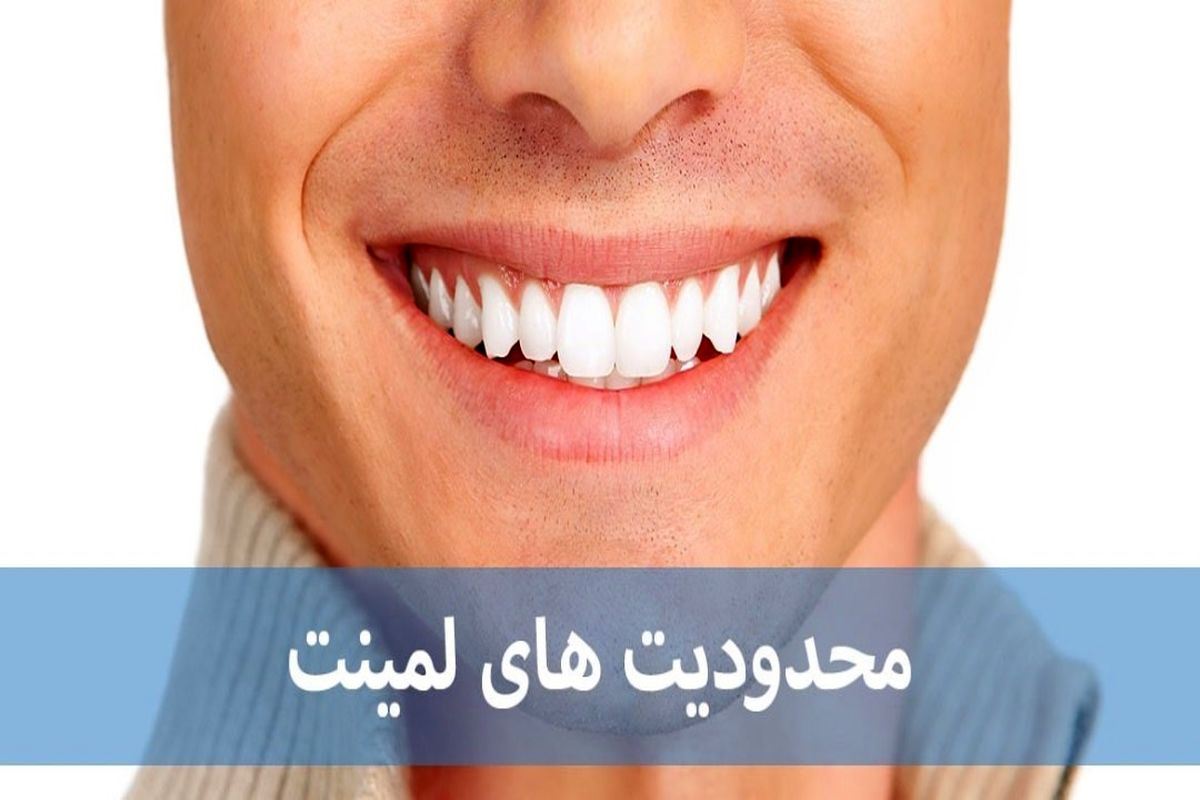 محدودیت های لمینت