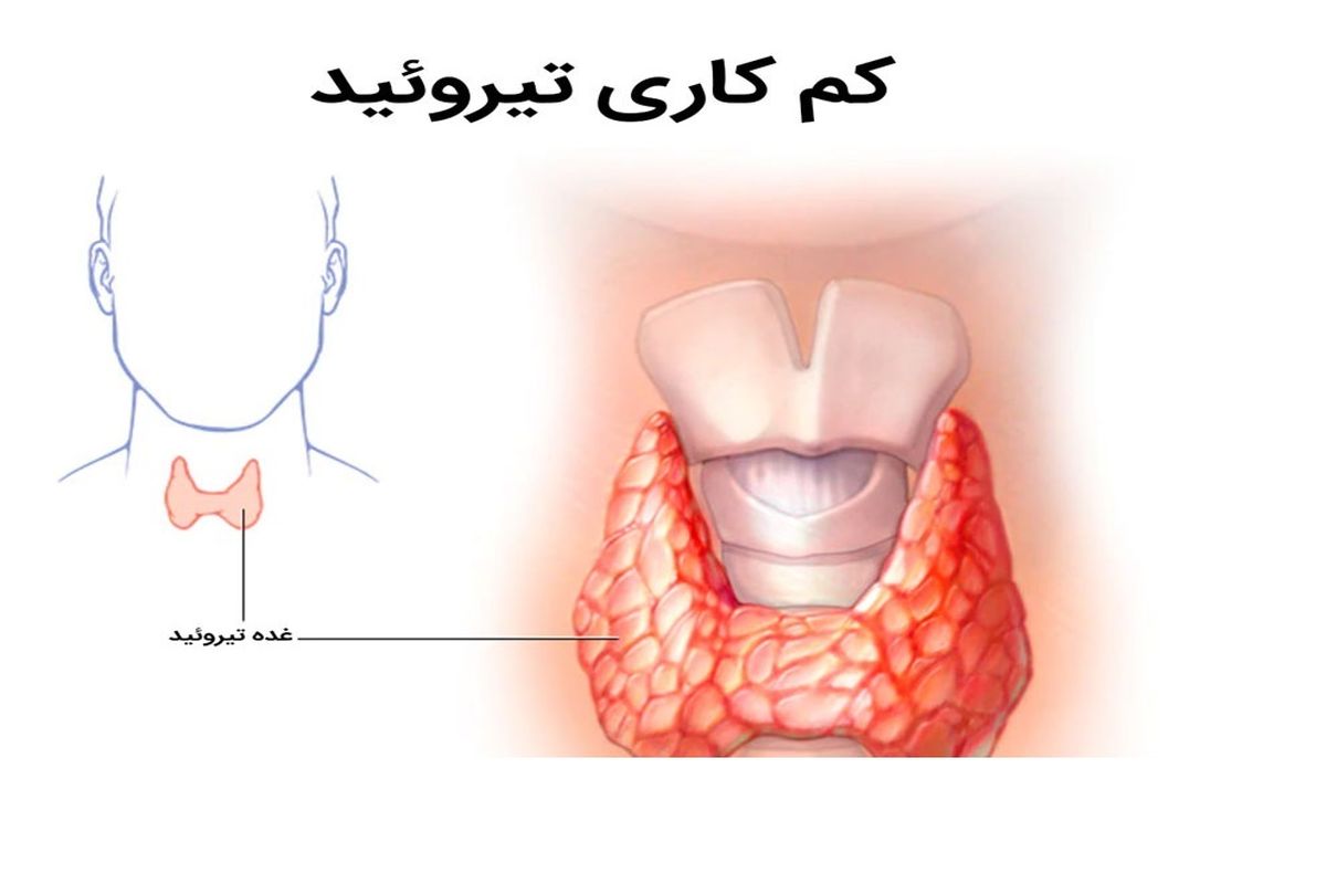 با کم ‌کاری مادرزادی تیروئید بیشتر آشنا شویم