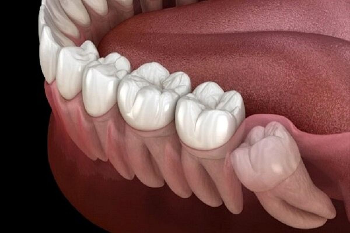 پس از سال ها علت رویش دندان عقل در بزرگسالی مشخص شد