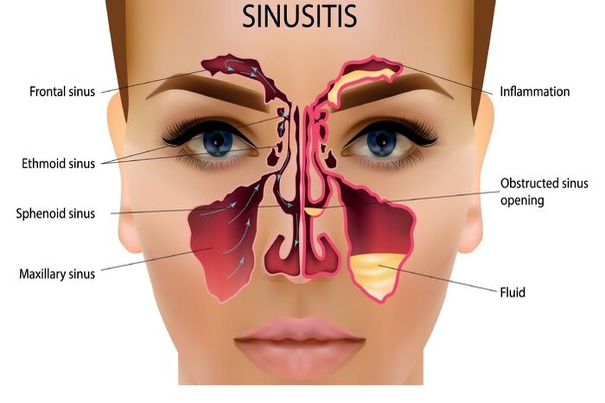 نحوه صحیح تشخیص بیماری سینوزیت از سرماخوردگی