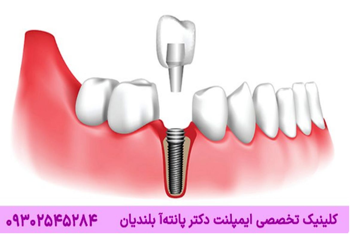 ۱۱ حقیقت مهم در مورد ایمپلنت دندان