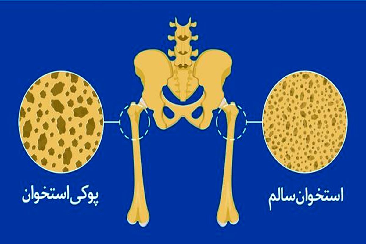 چگونه از پوکی استخوان در امان بمانیم؟ بیماری دشواری که پیش گیری ساده ای دارد