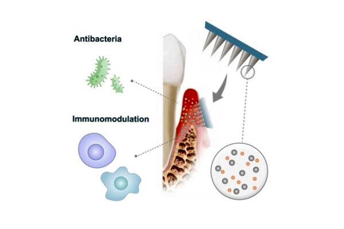 روش جدیدی برای احیای بافت‌های مبتلا به عفونت لثه ابداع شد