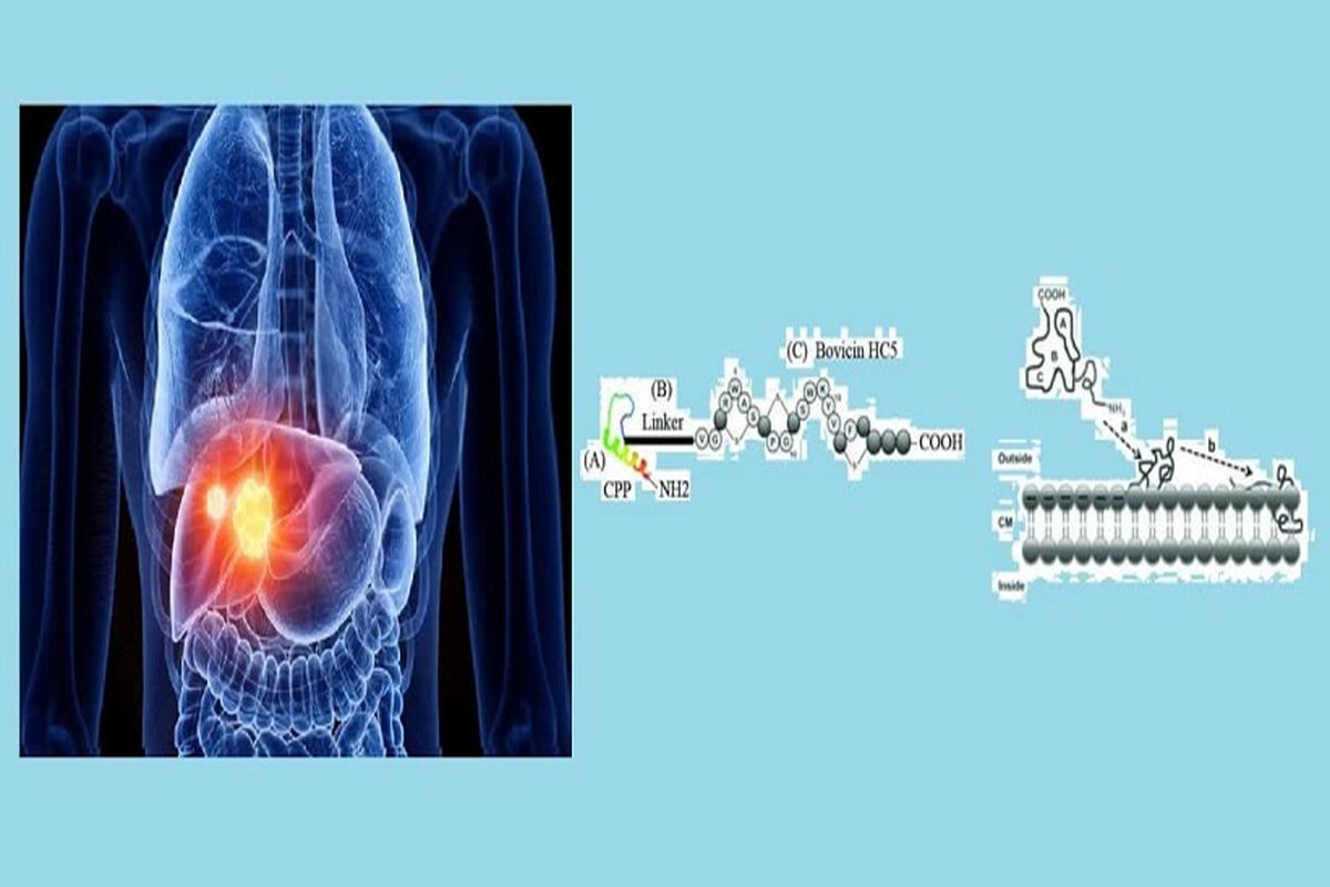 روش نوین درمان سرطان کبد