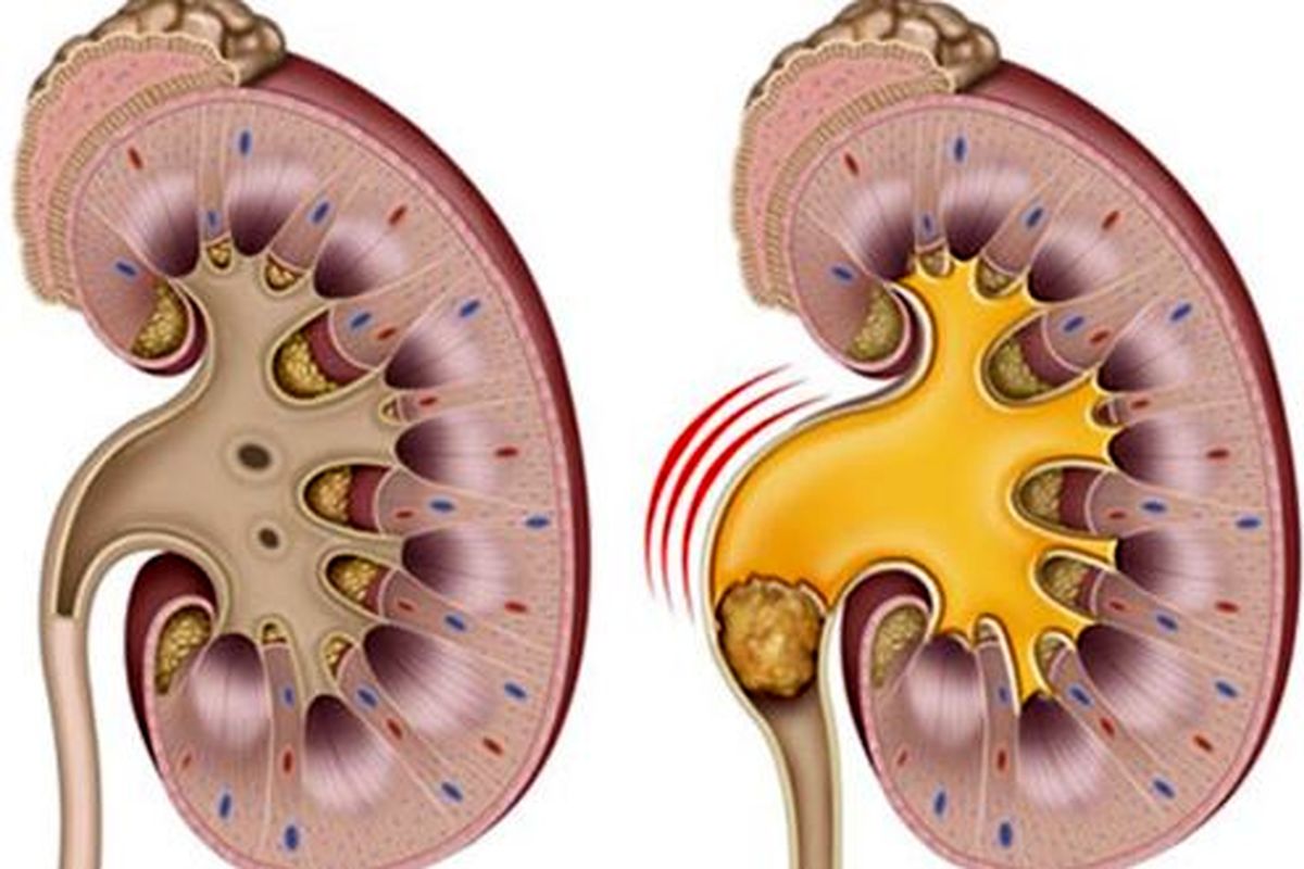 رژیم غذایی بیشترین تأثیر را بر سنگ کلیه دارد