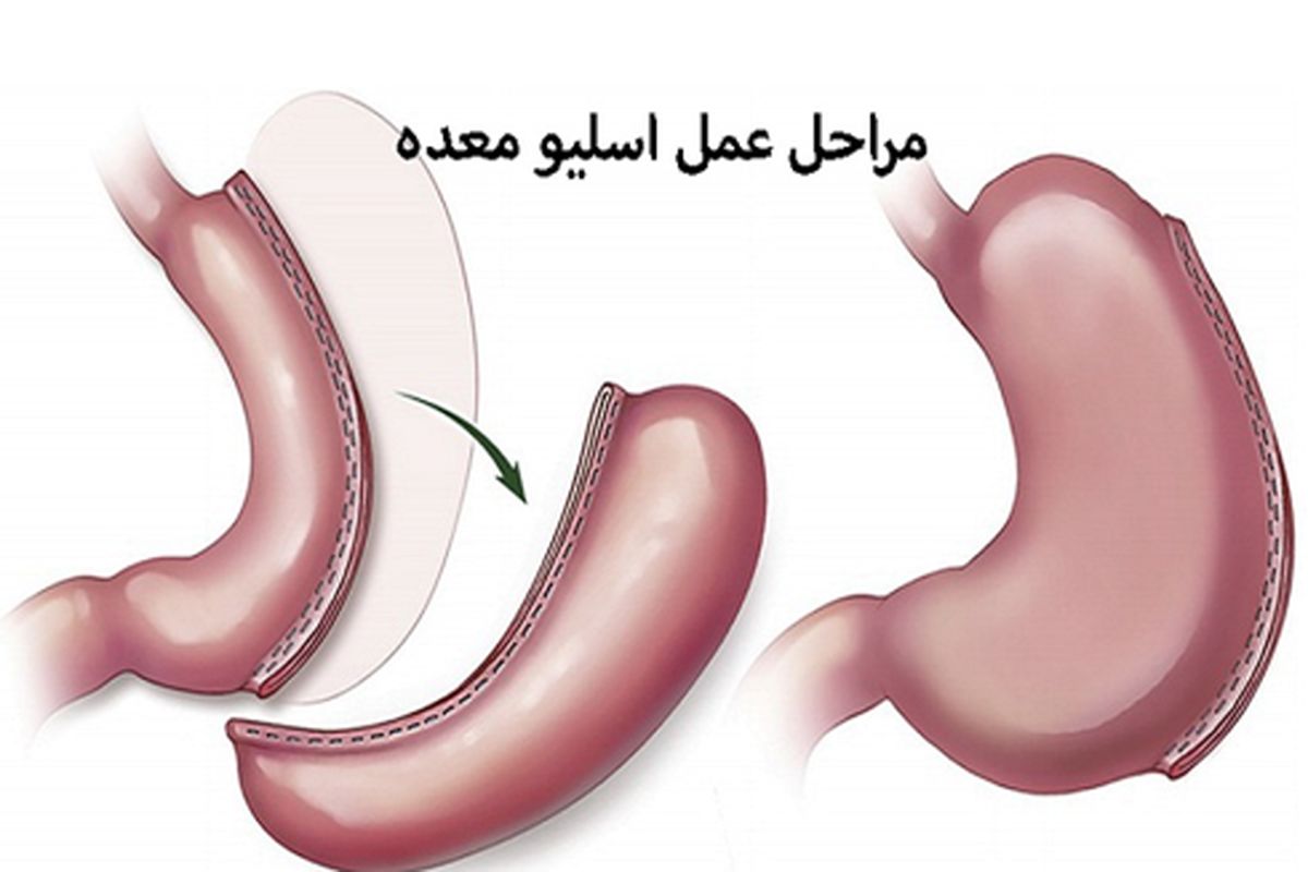 عمل اسلیو معده چیست؟ + آنچه که قبل از عمل باید بدانید