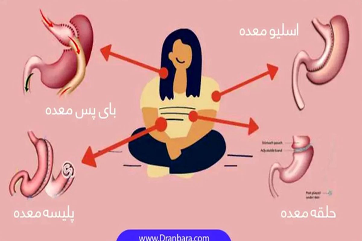 معرفی بهترین روش های جراحی لاغری