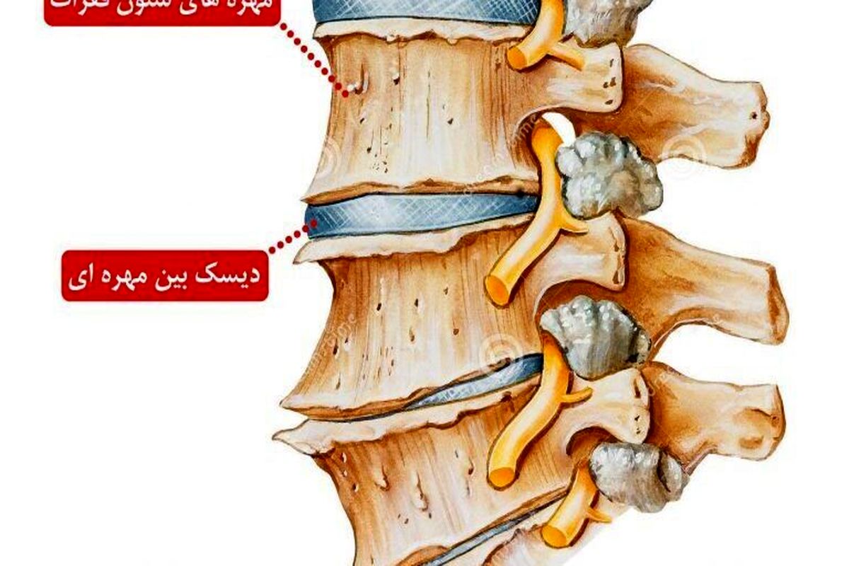 فناوران ایرانی داربستی برای بافت لیفی دیسک بین مهره‌ای ساختند