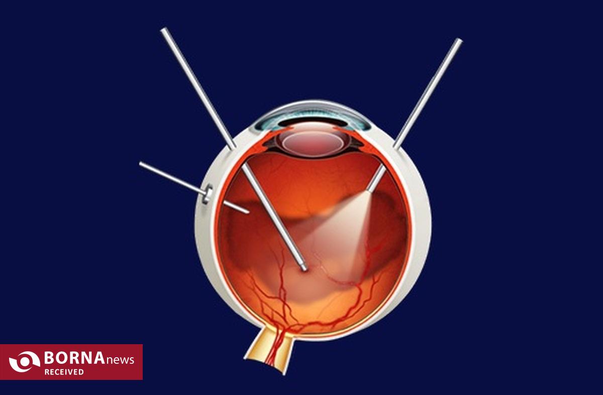 بازگشت بینایی با پیوند سلول‌های بنیادی!