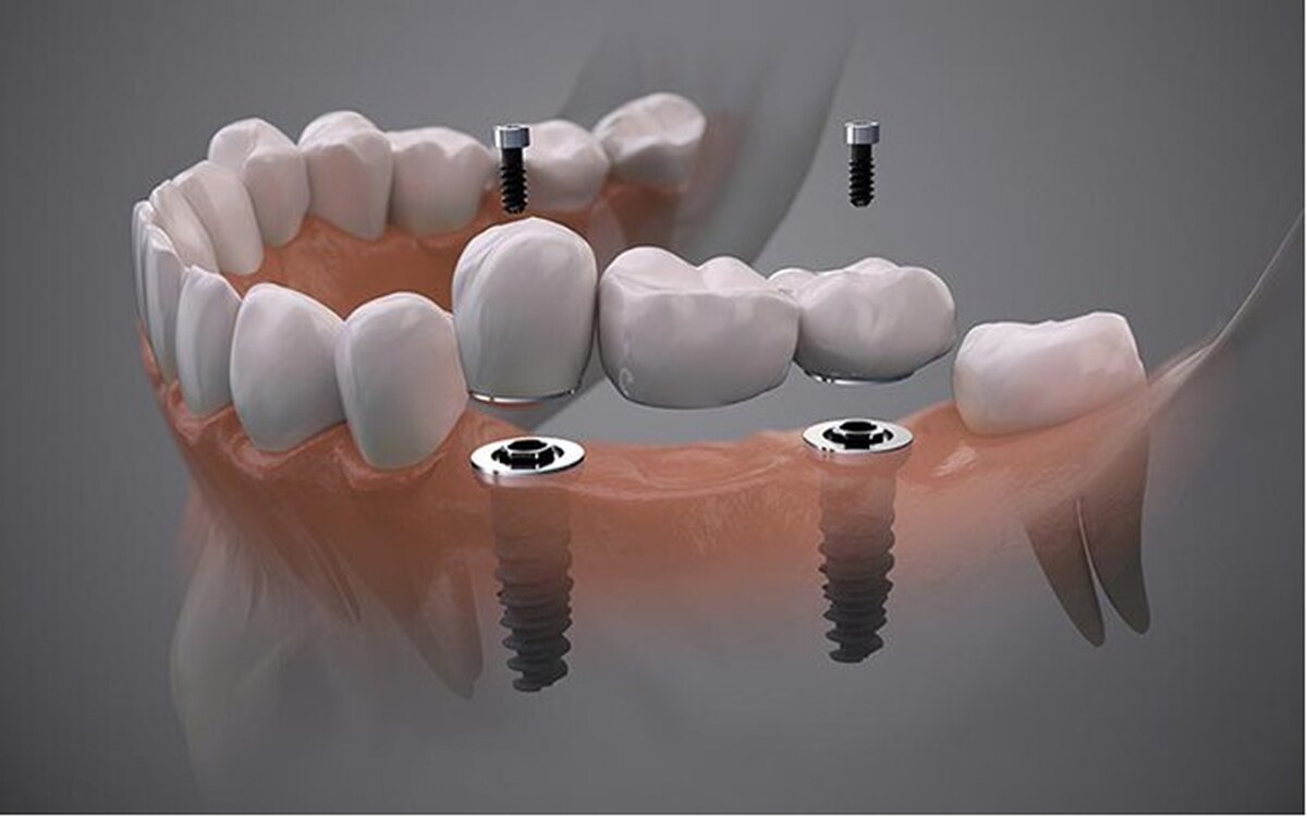 ایمپلنت دیجیتال مناسب چه کسانی است؟